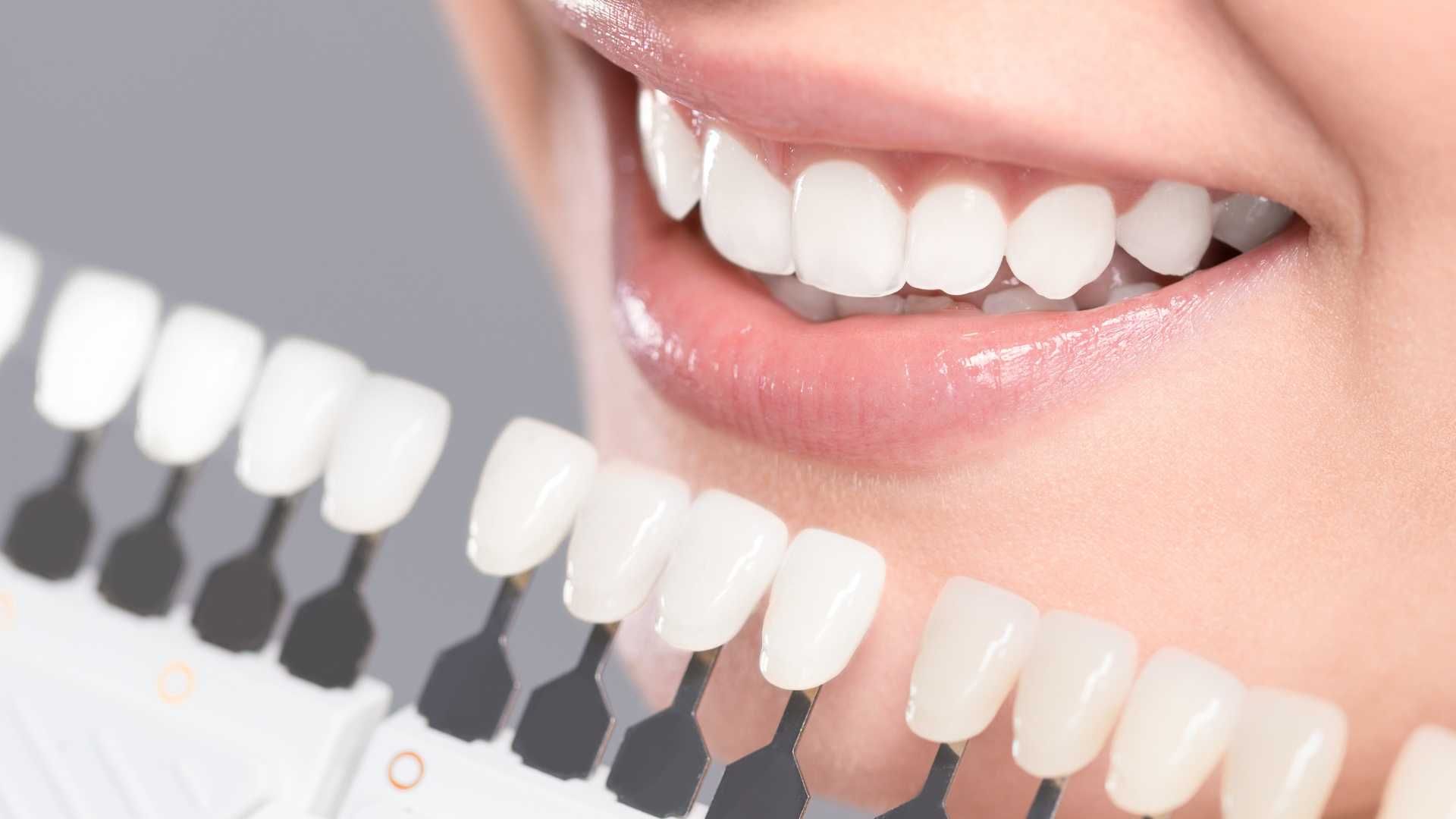 روکش تمام‌سرامیک در مشهد