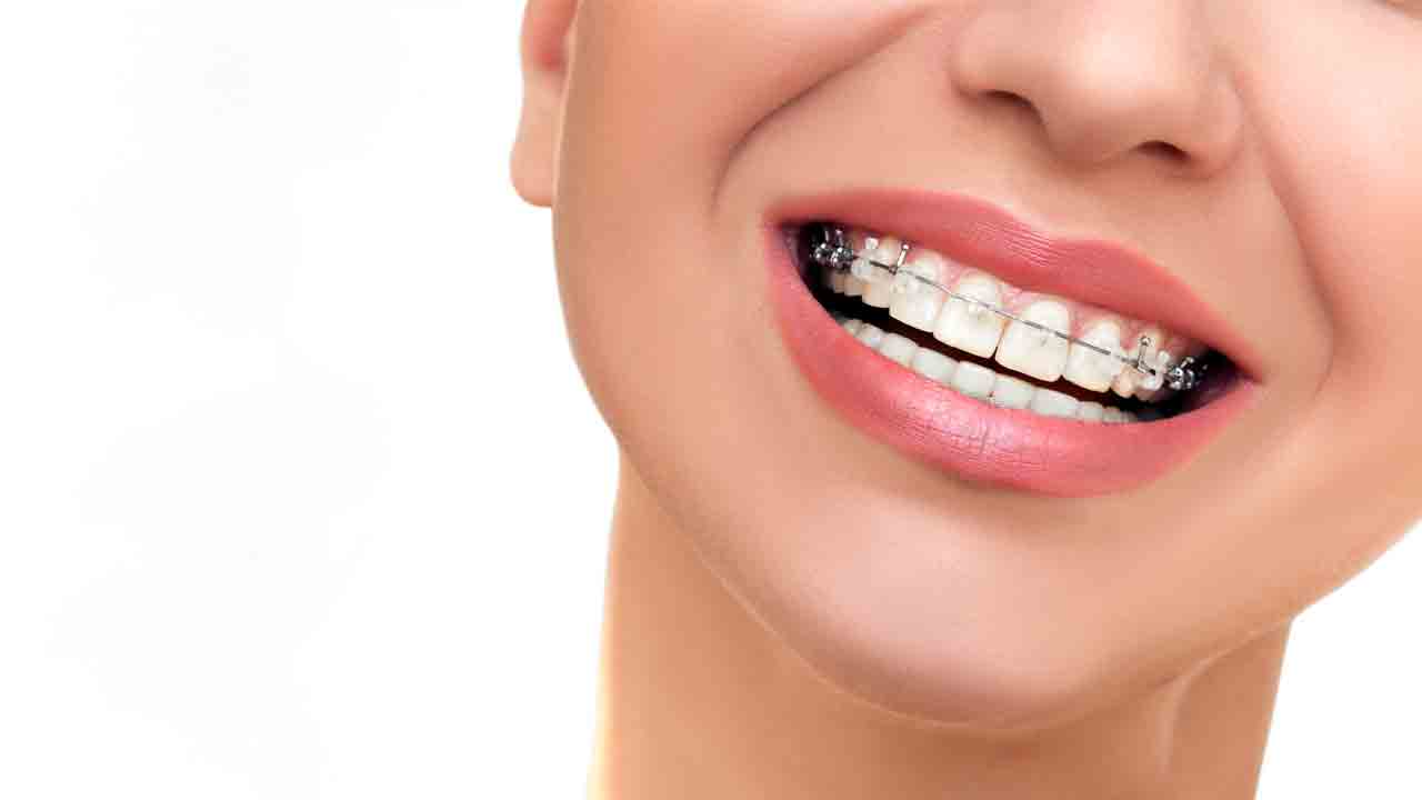 ارتودنسی ثابت در مشهد