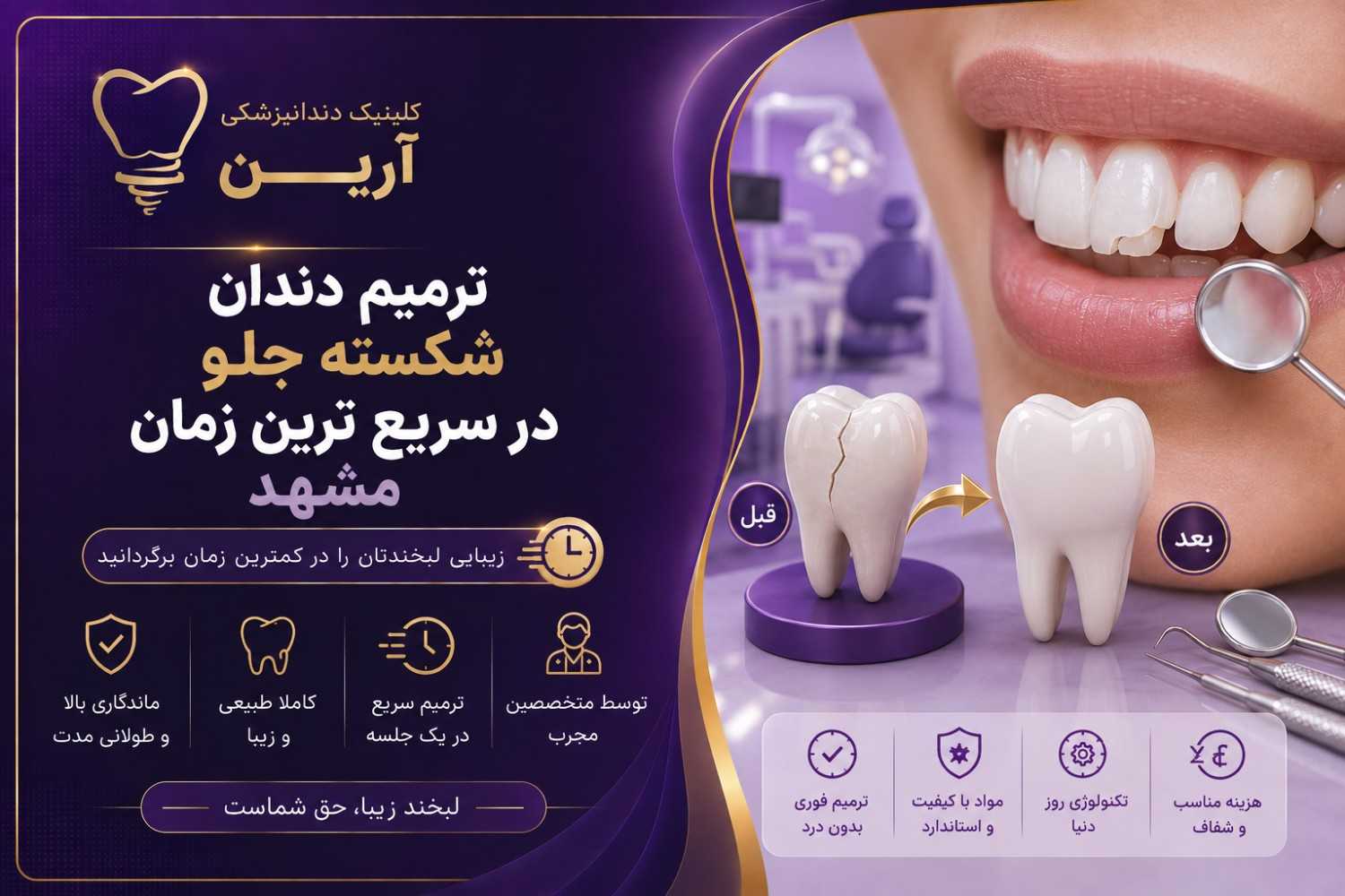 ترمیم دندان شکسته جلو در سریع ترین زمان مشهد